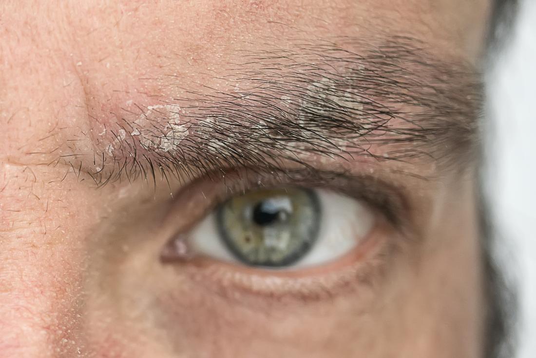 homem com psoríase na sobrancelha