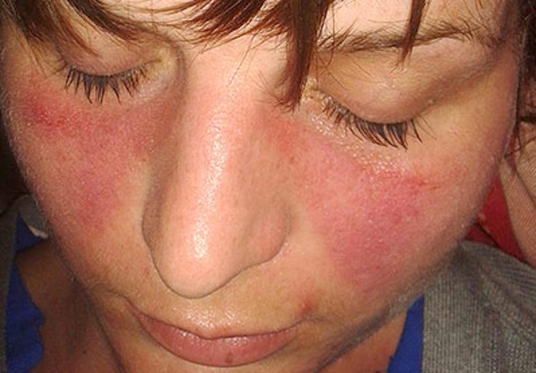 A erupção malar é um sintoma de lúpus.  Crédito da imagem: Doktorinternet, 2013.