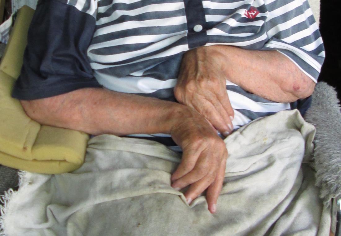 Desvio ulnar em pessoas com artrite reumatóide.  Crédito da imagem: Aljeannoir, 2015.