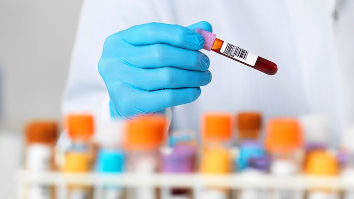 Exame de sangue detecta síndrome de Down durante a gravidez
