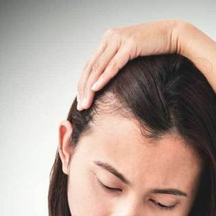 female pattern hair loss
