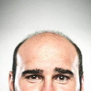 perda de cabelo padrão masculino