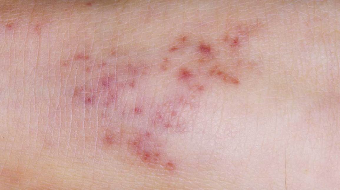 meningite