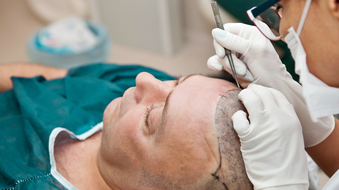 hair transplant 1296x728 header