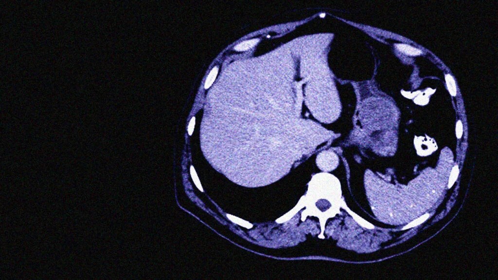 Uma tomografia computadorizada de um tumor estromal gastrointestinal (essência)